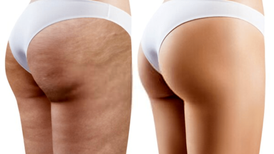 Qu’est ce que la cellulite ? comment la traiter ?