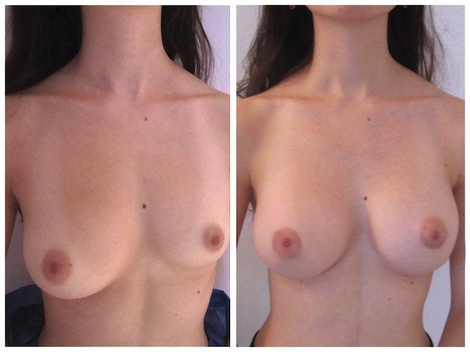 chirurgie de révision des implants mammaires