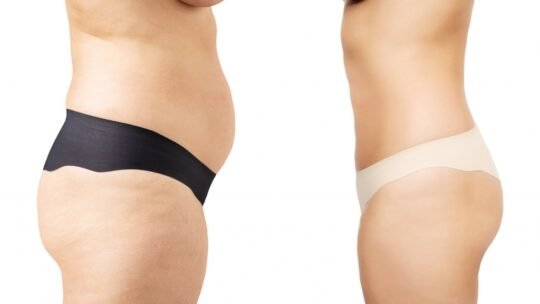 Quel type d’abdominoplastie me convient-il ?