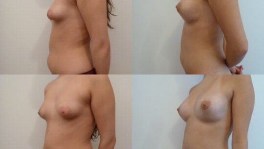 Lipofilling visage, seins et fessiers