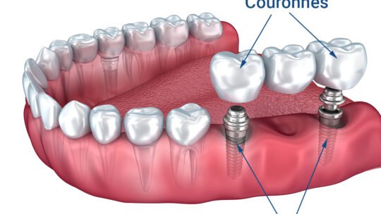 Implants et bridges dentaires