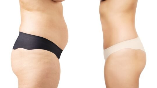 Tout savoir sur abdominoplastie