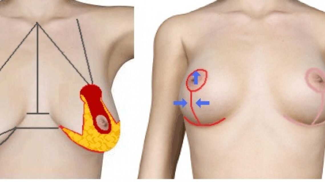 Qu’est-ce que la reconstruction mammaire (Mastopexie) ?