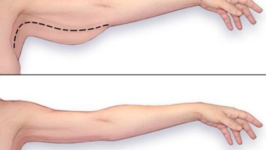 Qu’est-ce qu’une brachioplastie ?