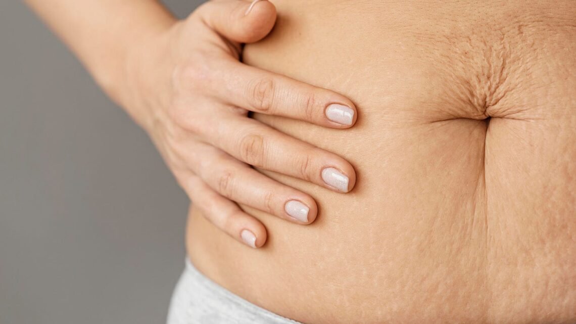 La Cellulite : mythes, réalités et solutions pour une peau lisse