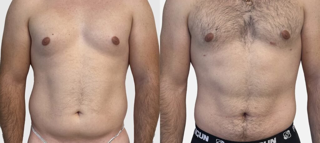 abdominoplastie avec ou sans lipo
