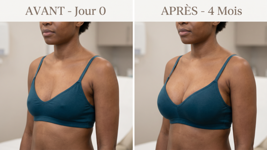 Lipofilling Mammaire HD : Nouvelle Génération d&rsquo;Augmentation Naturelle des Seins