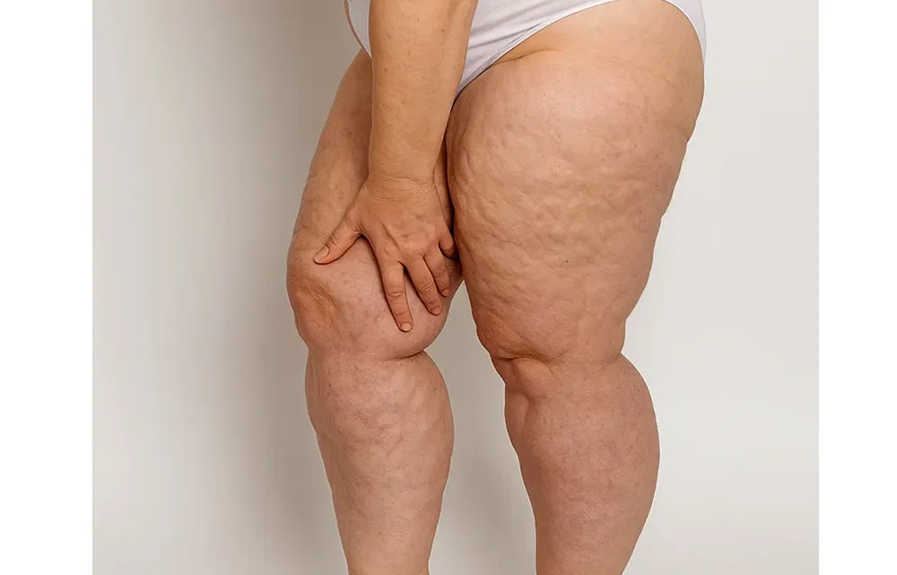 LIPŒDÈME :  Diagnostic, traitement et vérités